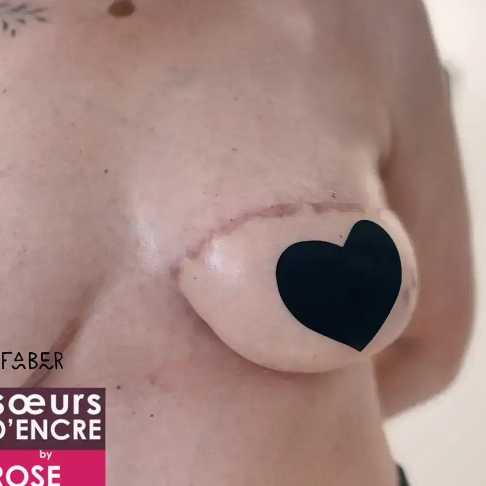 Tatouage reconstructeur cicatrice - avant